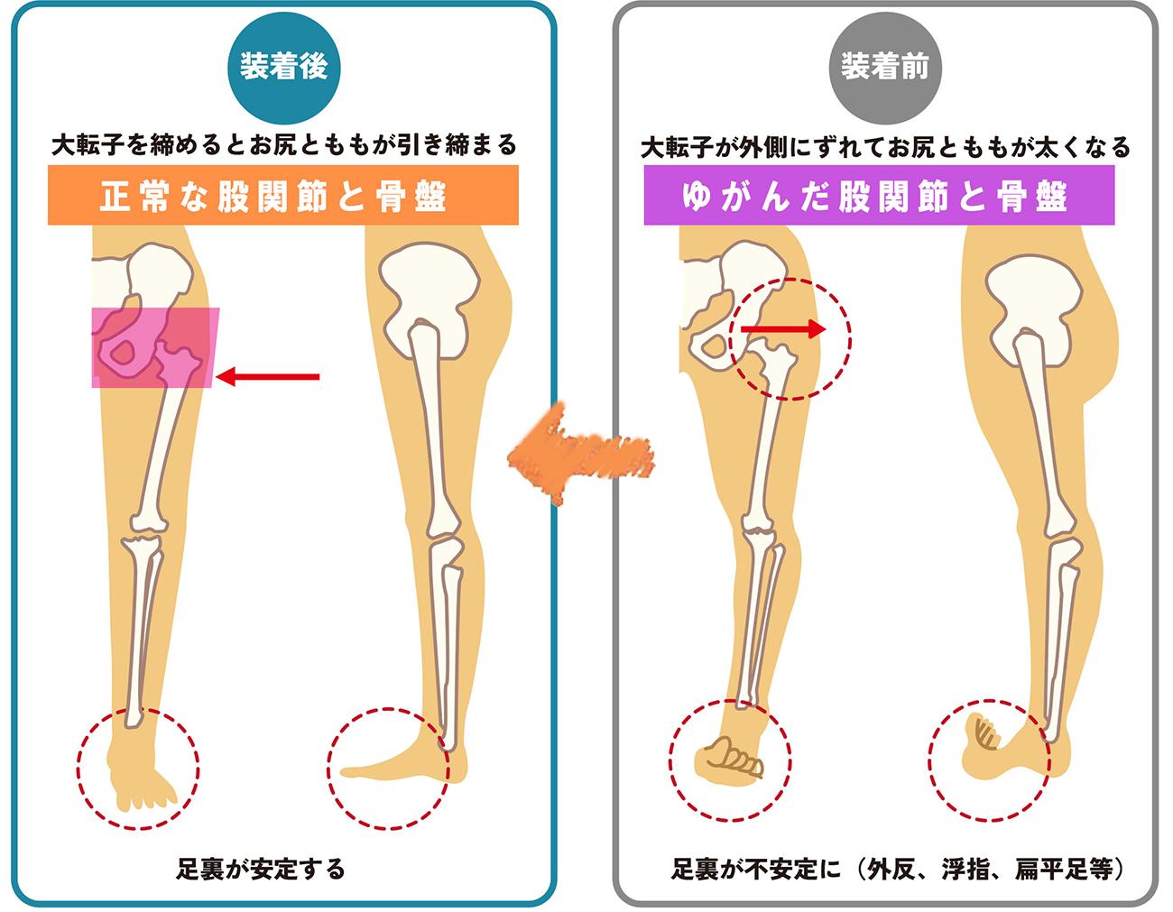 ソルボ股関節サポーター装着でゆがみ補整