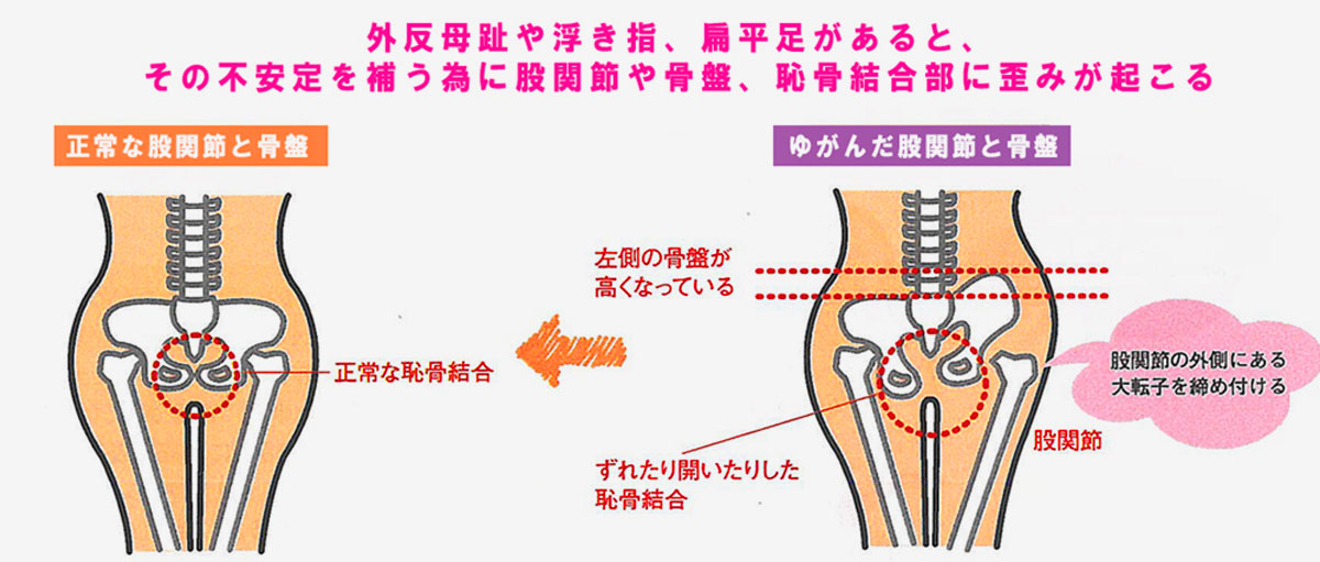 外反母趾から股関節がゆがむ